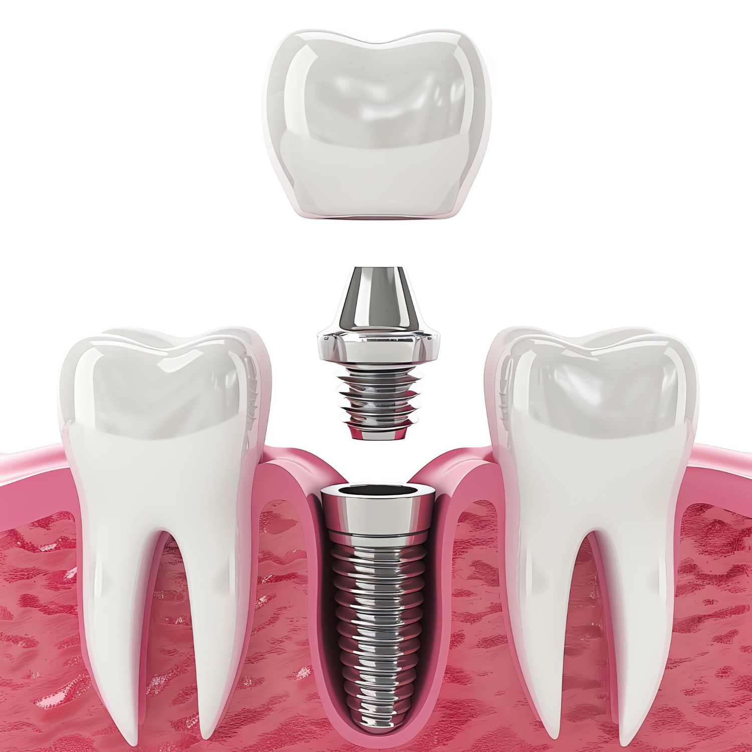 Dental Implants